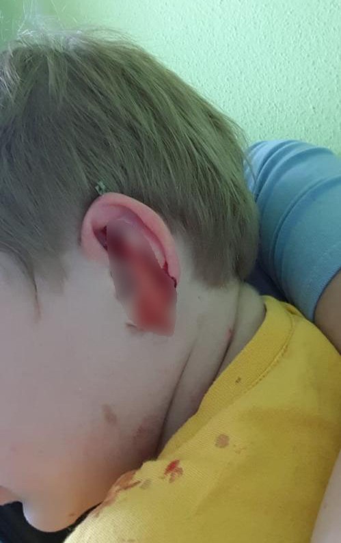 Двухлетний ребенок в Екатеринбурге во время прогулки в детсаду насквозь проткнул ушную раковину